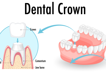 Dental Crowns