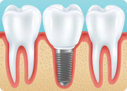 Dental Implants